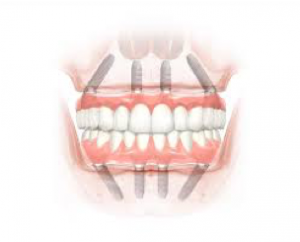 Einsatz von (Teil-)Prothesen, traditionelle Form eines Zahnersatzes und Fixierungen über Zahnimplantate | Zahnarzt Straubing